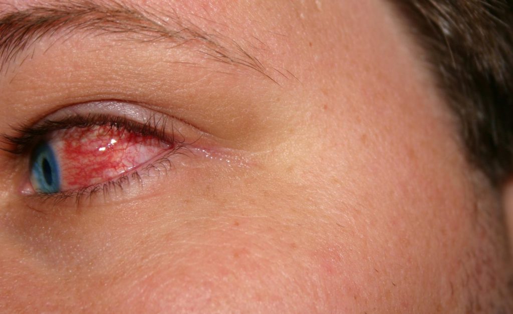 Hvilke fordele og ulemper ved øjendråber bør du være opmærksom på?